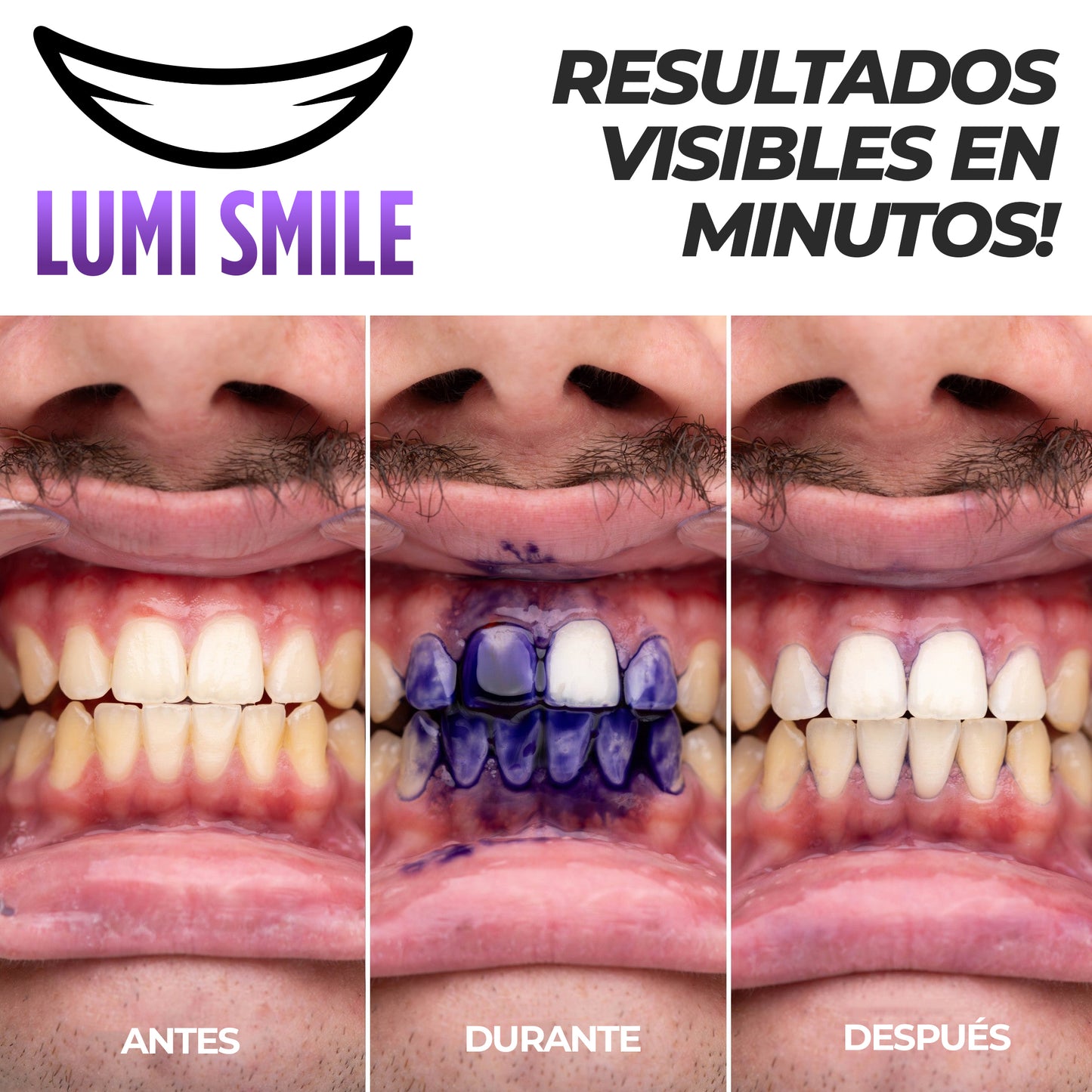 LumiSmile™ - Pasta correctora de color