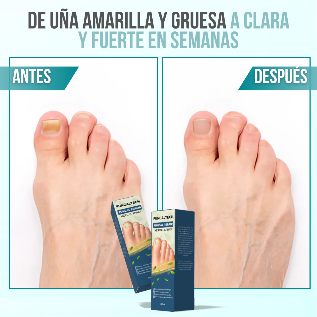 FungalTech™ - Recupera la salud de tus uñas de manera rápida y natural