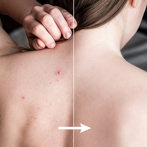 SPRAY TRATAMIENTO DEL ACNE Y MANCHAS - BackAcne™