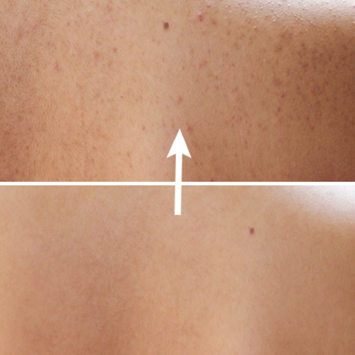 SPRAY TRATAMIENTO DEL ACNE Y MANCHAS - BackAcne™