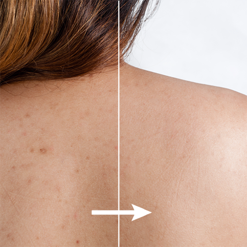 SPRAY TRATAMIENTO DEL ACNE Y MANCHAS - BackAcne™