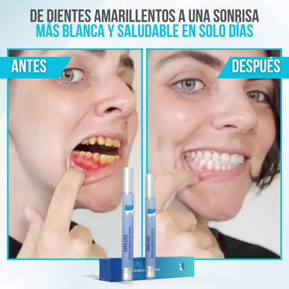Smiluxe™ - Blanquea, protege y deslumbra con cada sonrisa