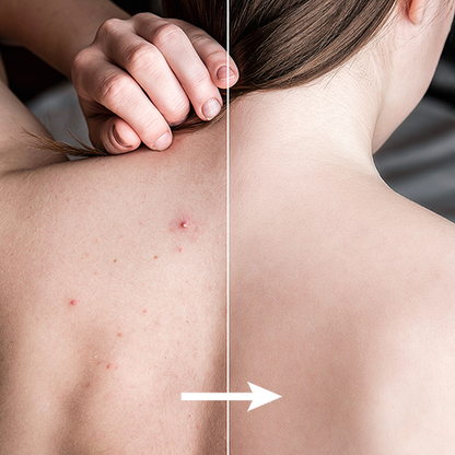 SPRAY TRATAMIENTO DEL ACNE Y MANCHAS - BackAcne™