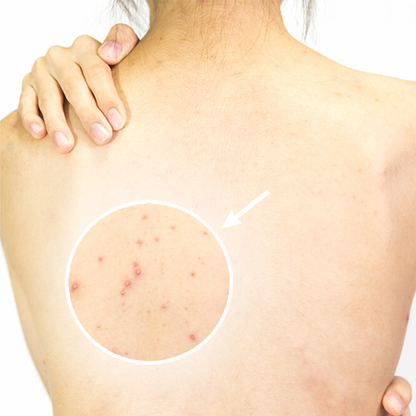 SPRAY TRATAMIENTO DEL ACNE Y MANCHAS - BackAcne™
