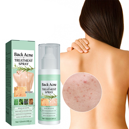 SPRAY TRATAMIENTO DEL ACNE Y MANCHAS - BackAcne™