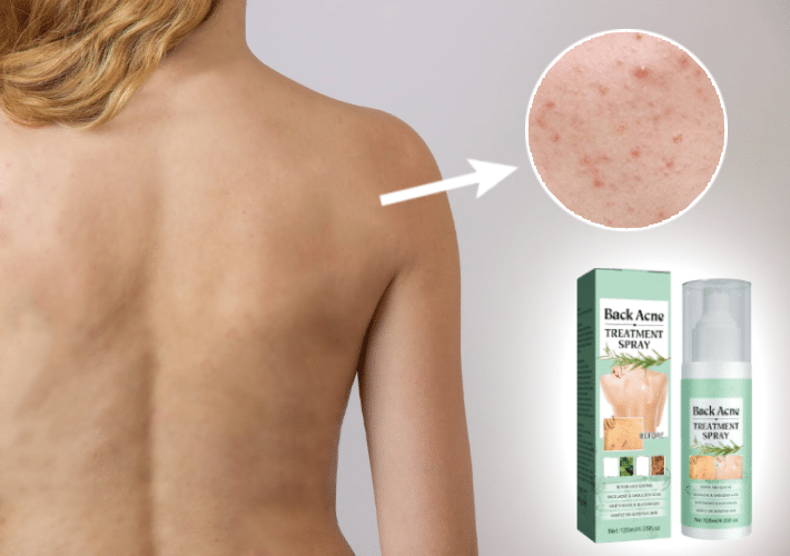 SPRAY TRATAMIENTO DEL ACNE Y MANCHAS - BackAcne™