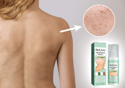 SPRAY TRATAMIENTO DEL ACNE Y MANCHAS - BackAcne™